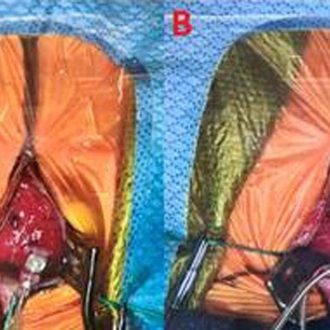 28-week-old infant with tiny pacemaker implanted by specialists at Norton Children's Heart Institute